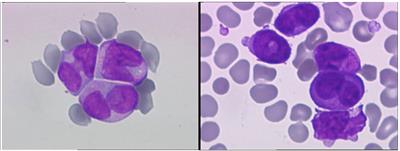 Case report: High-risk acute promyelocytic leukemia and COVID-19-related myocarditis one patient, two cytokine storms